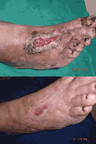 Before & After Pictures of an Ozone Treated Wound